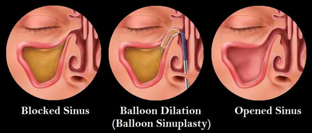 Balloon Sinuplasty North Texas Sinus P A