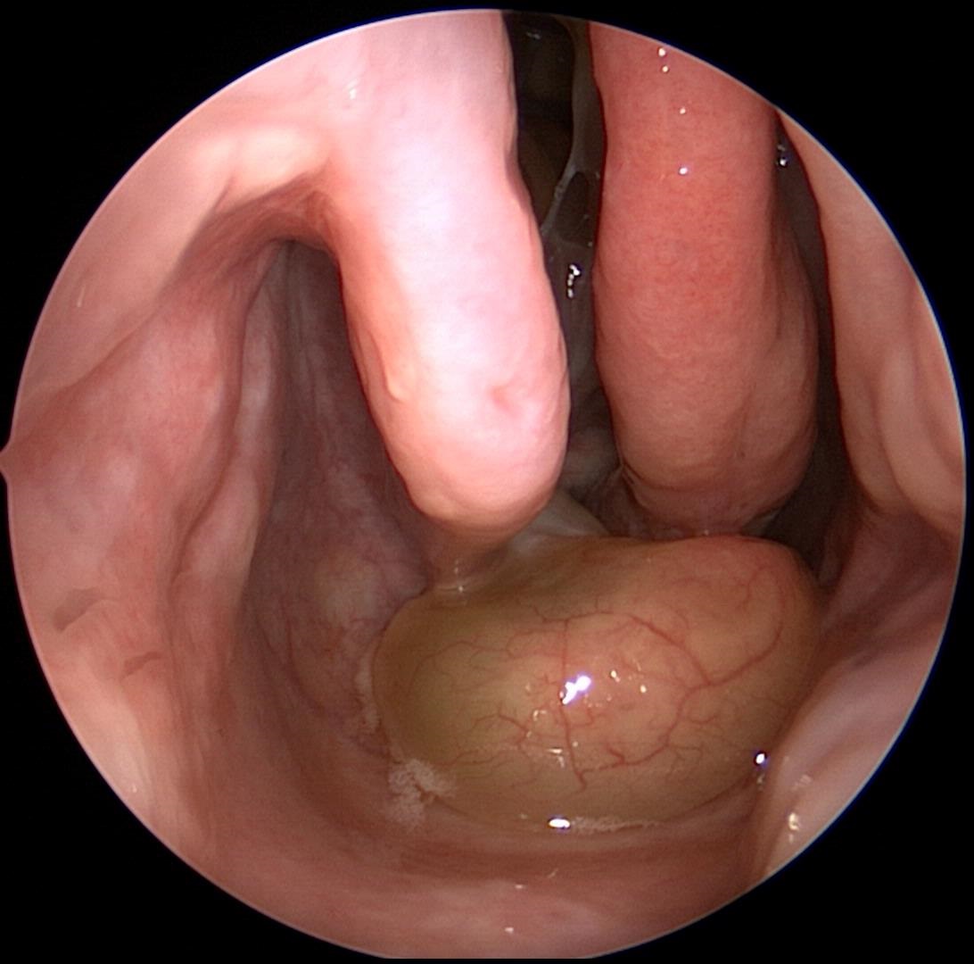 12.Conditions.Nose.NasalPolyps