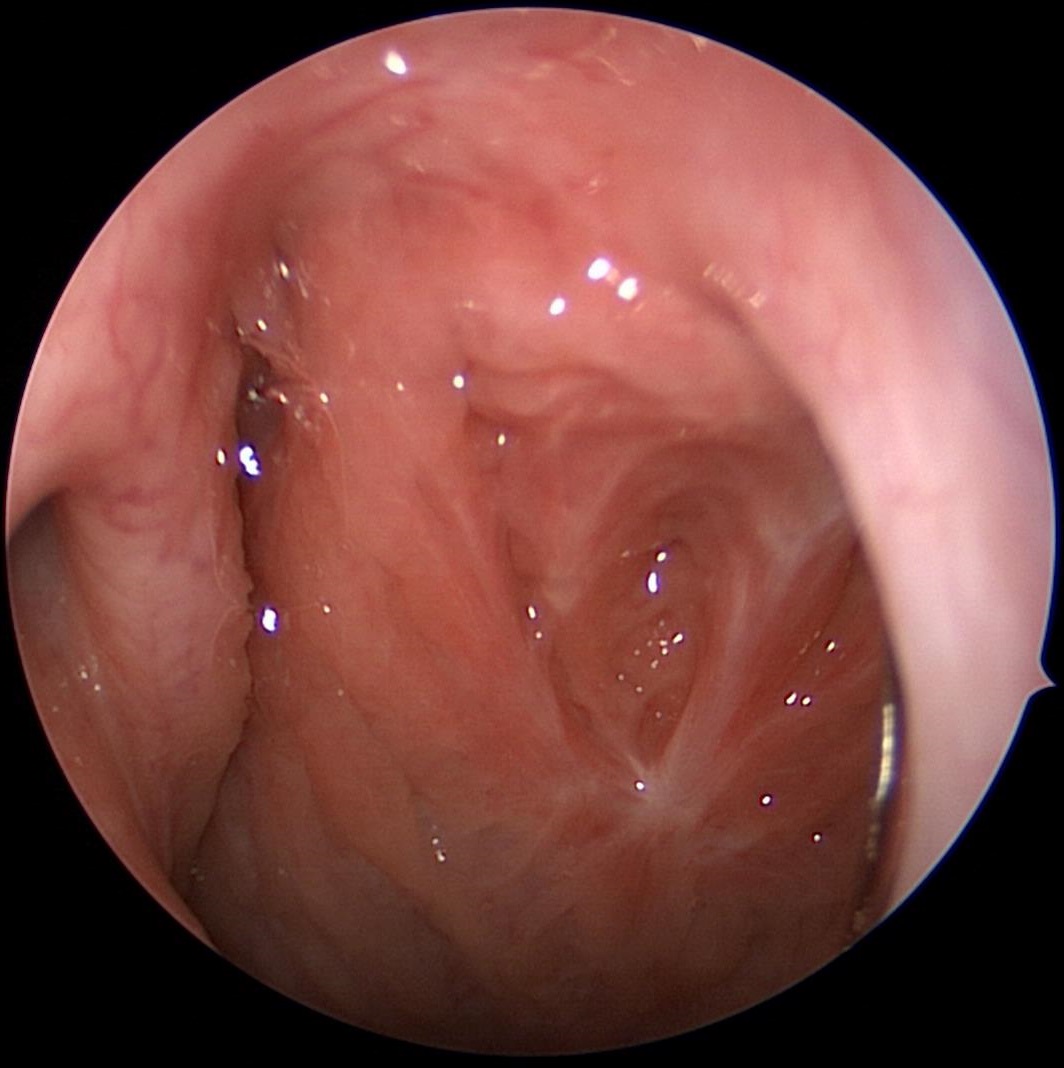 Adenoid Bed After Adenoidectomy