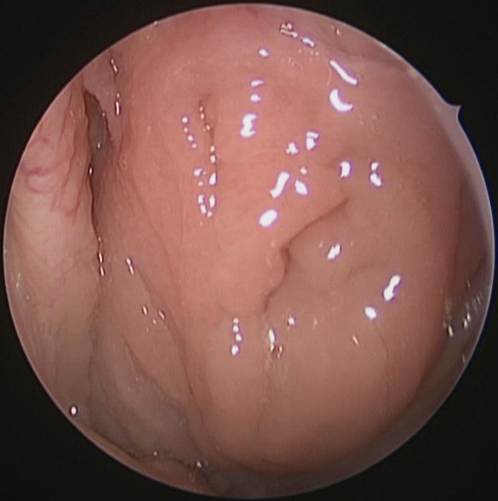 Adenoids Before Adenoidectomy