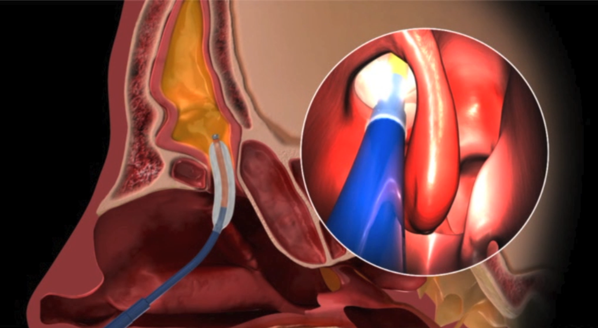 BalloonSinuplasty (column 3)