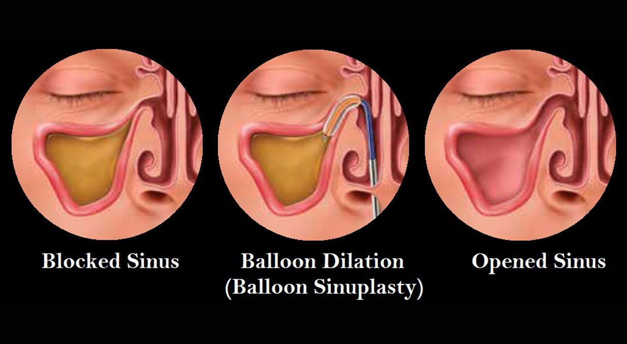 BalloonSinuplasty(use-middle-image-on-column-2)-1-2