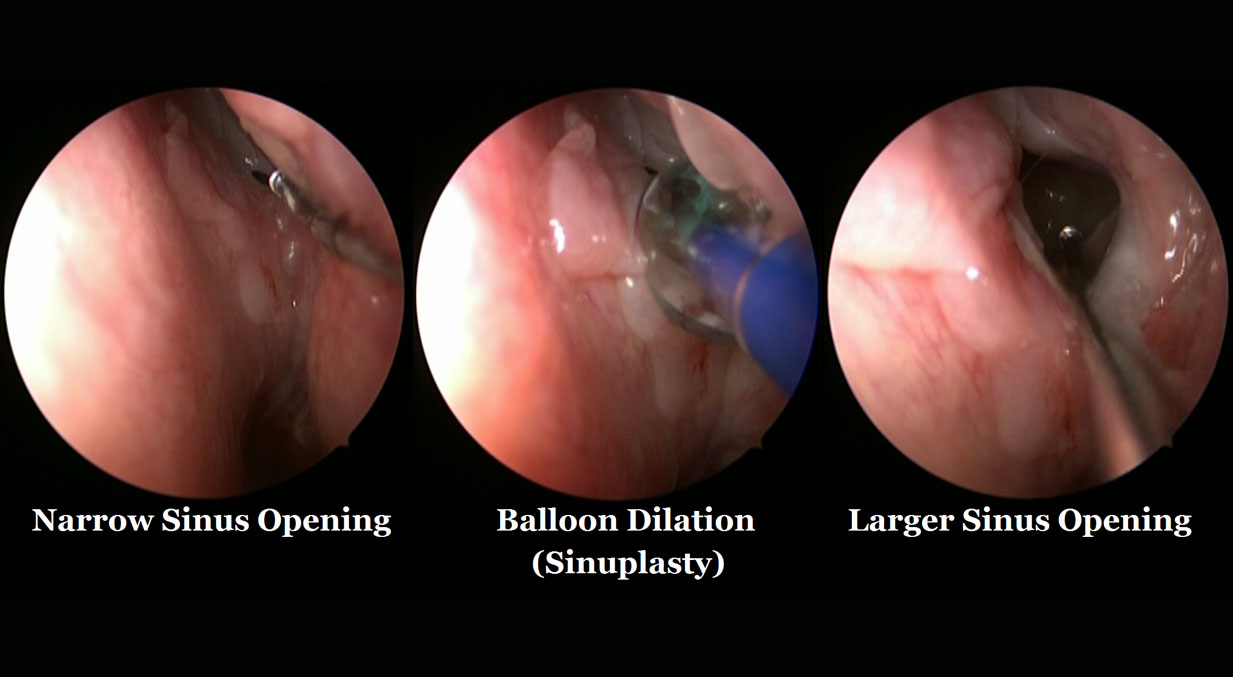 BalloonSinuplasty(use-middle-image-on-column-2)-1