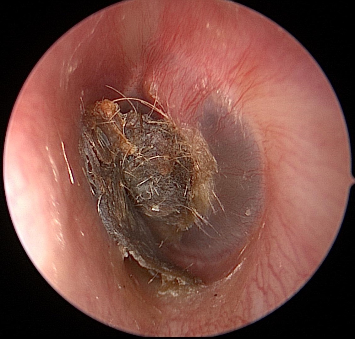 Cerumen (Ear Wax_1)