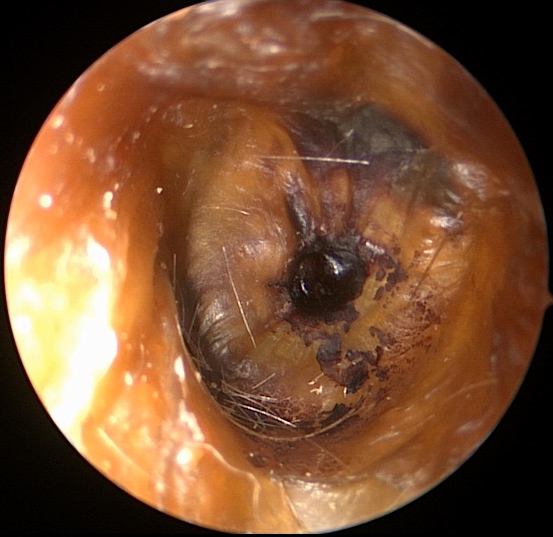 Cerumen (Ear Wax_2)