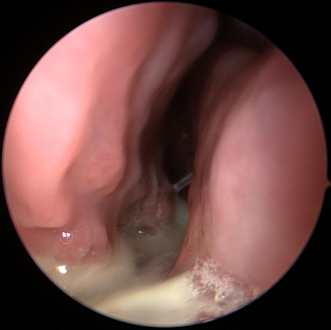 ChronicSinusitis