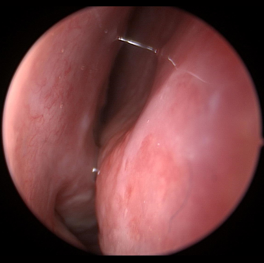 Deviated-Nasal-Septum-1