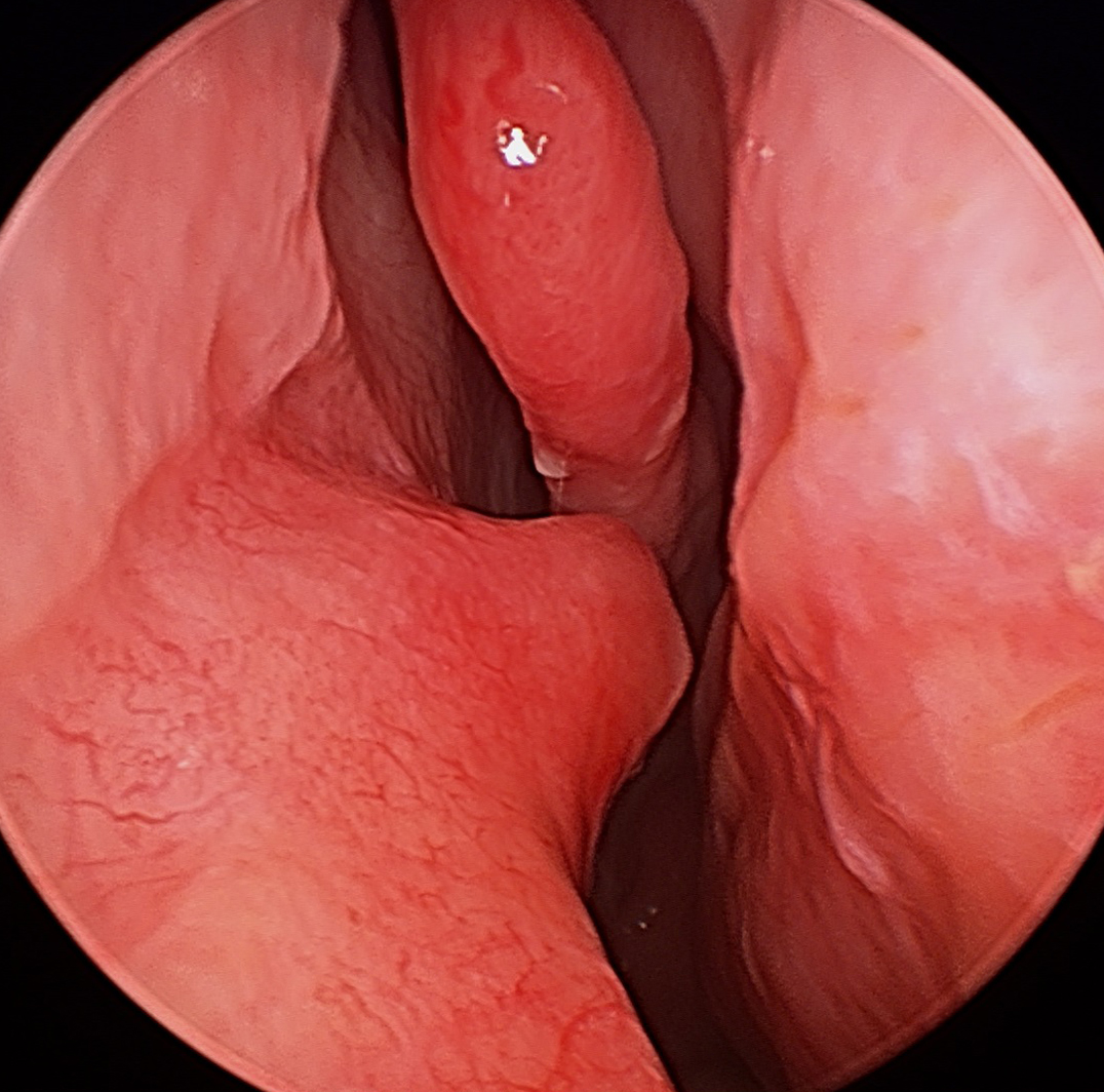 DeviatedNasalSeptum-1