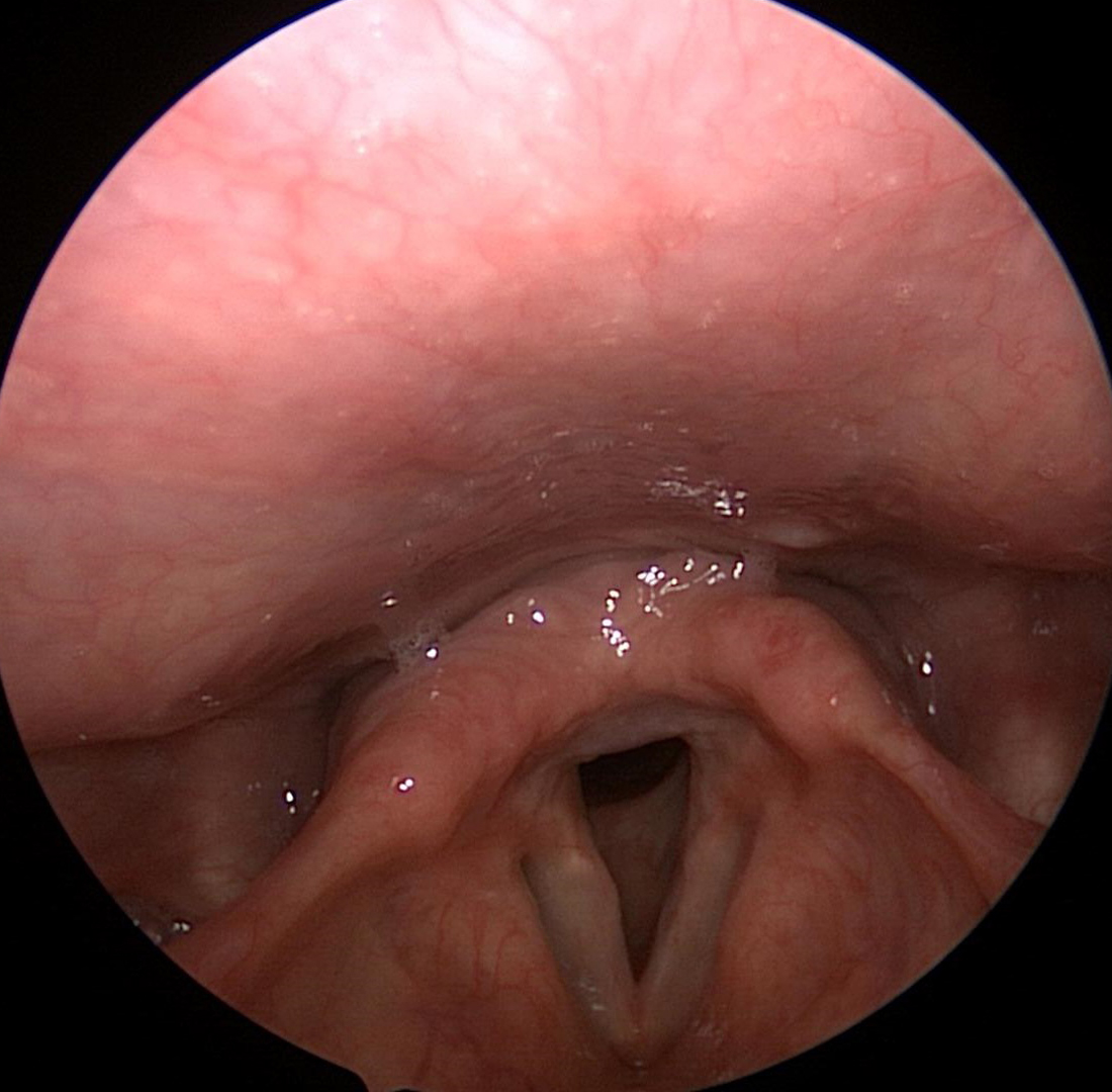 Direct-Laryngoscopy-1