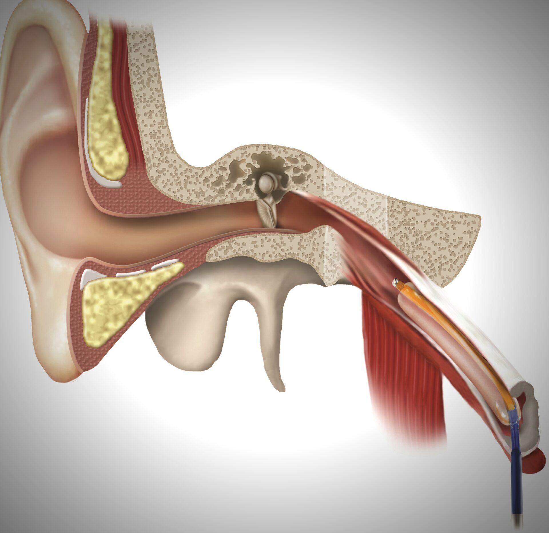 Eustachian Tube Balloon Dilation