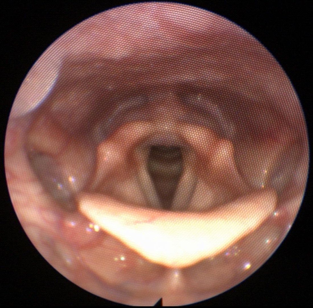 Flexible Fiberoptic Laryngoscopy