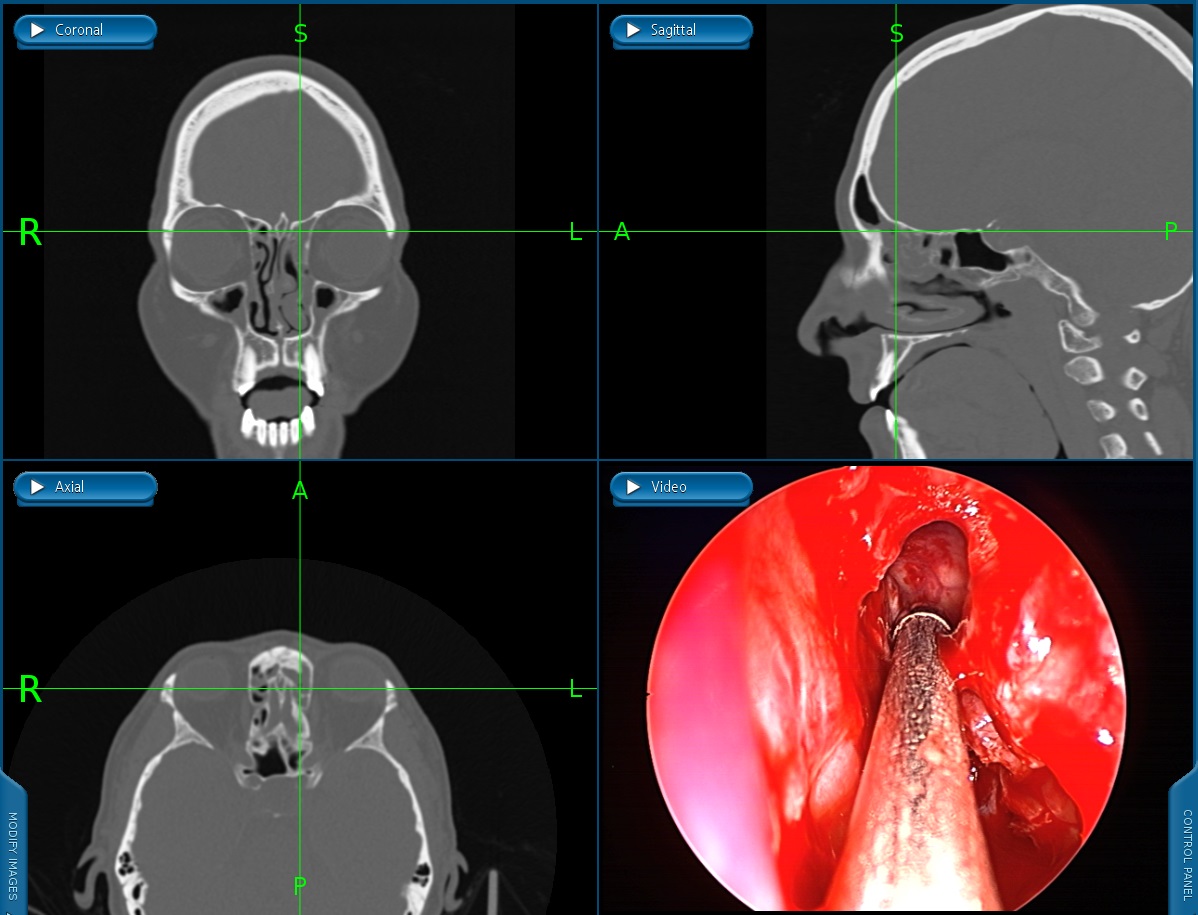 Frontal Sinus