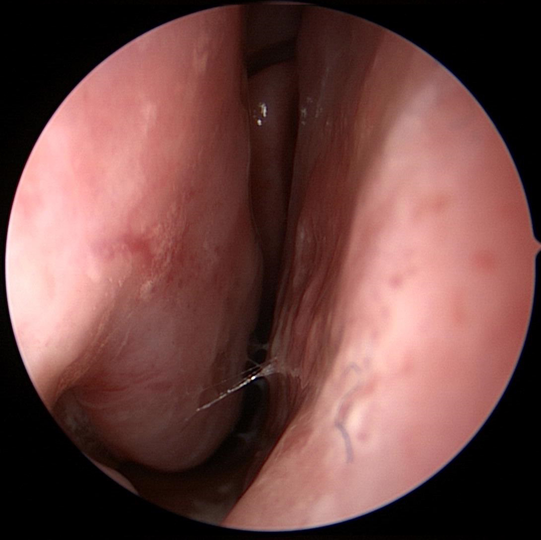Hypertrophied-Inferior-Turbinate-1
