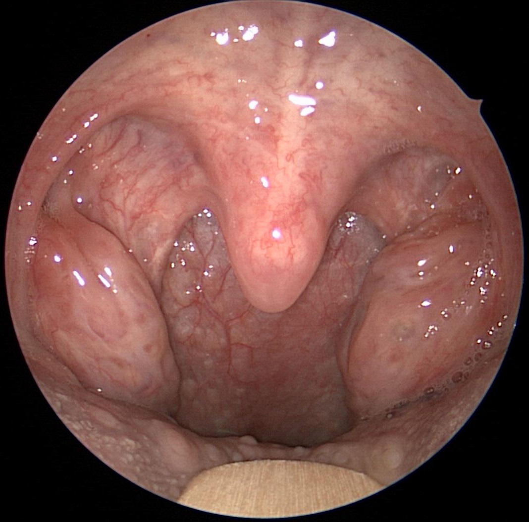 Hypertrophied Tonsils