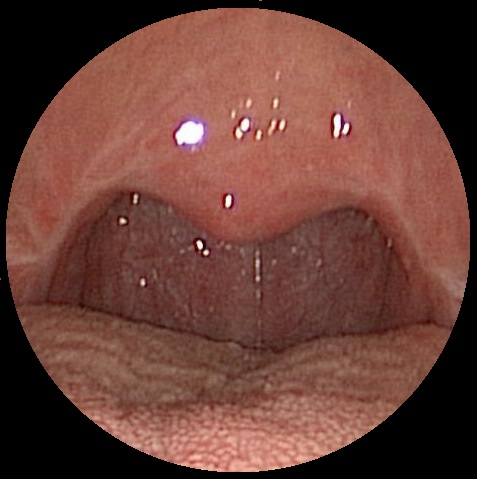 Improved Palate & Throat Airway