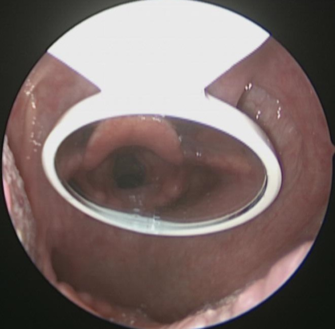 Indirect-Laryngoscopy-1