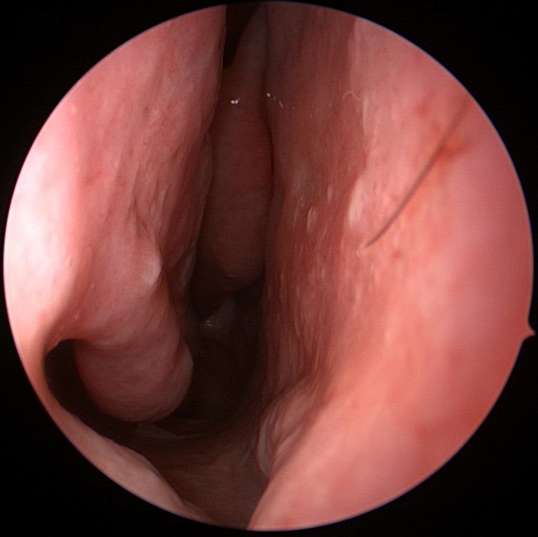 Inferior Turbinate After Reduction