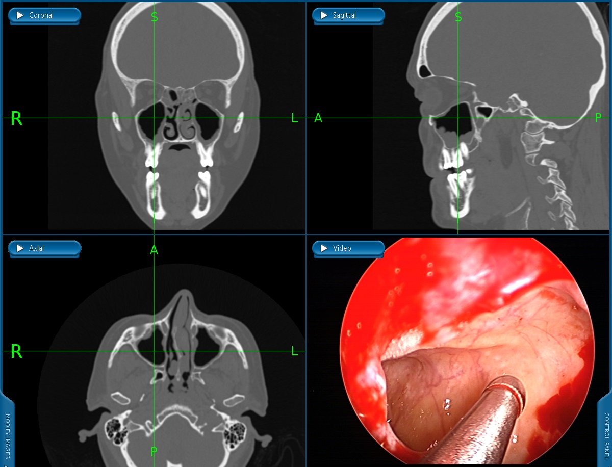 Maxillary Sinus