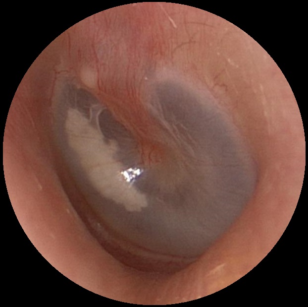 Myringosclerosis (Small)