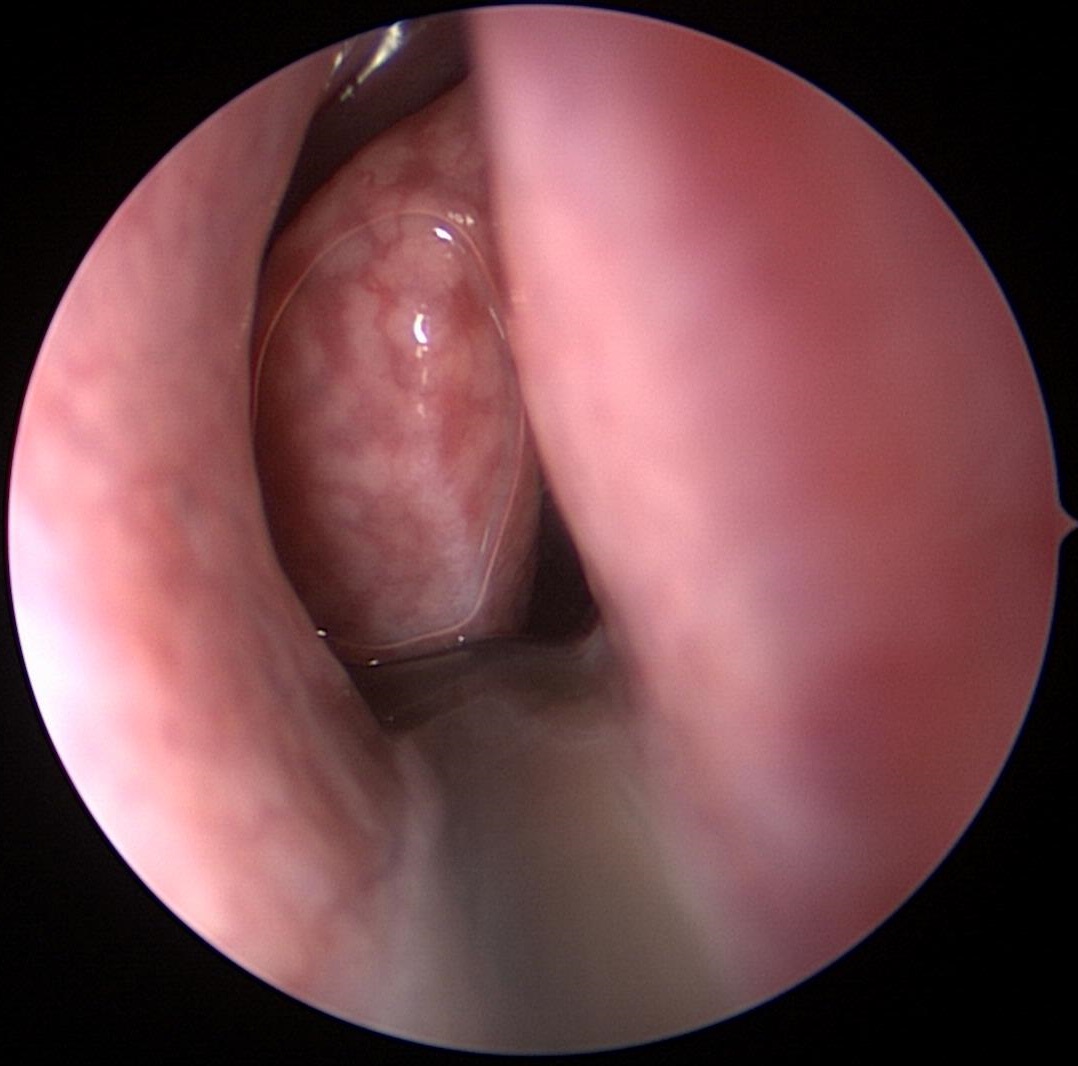 Nasal Endoscopy Showing Abnormal Severe Mucous Collecting In Nose