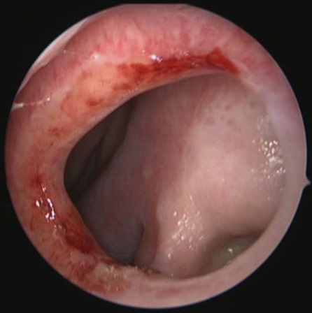 Nasal Septal Perforation