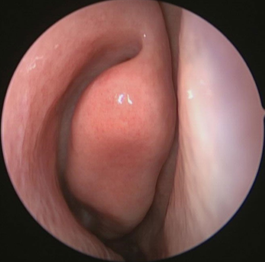 Normal-Nasal-Endoscopy-Showing-Middle-Turbinate-1