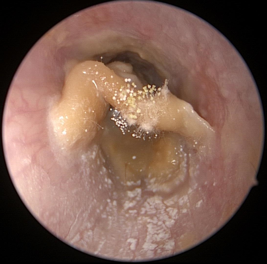 Otomycosis (Fungus_1)