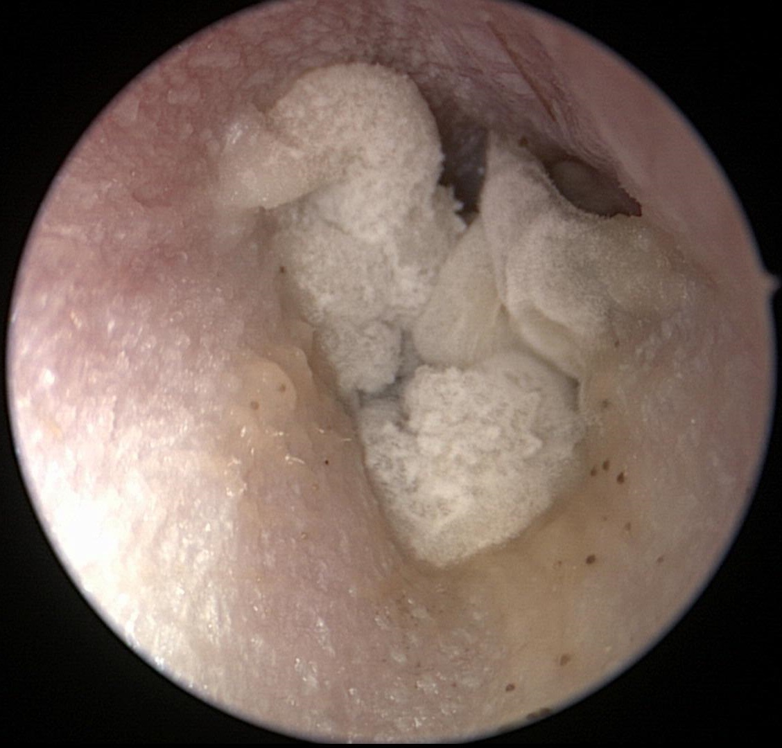 Otomycosis (Fungus_2)