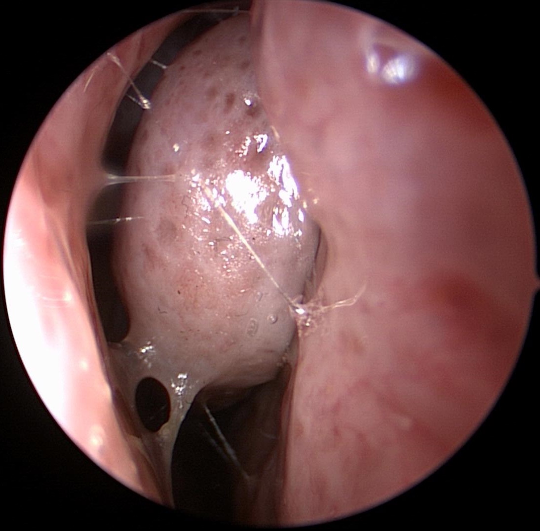 RecurrentSinusitis