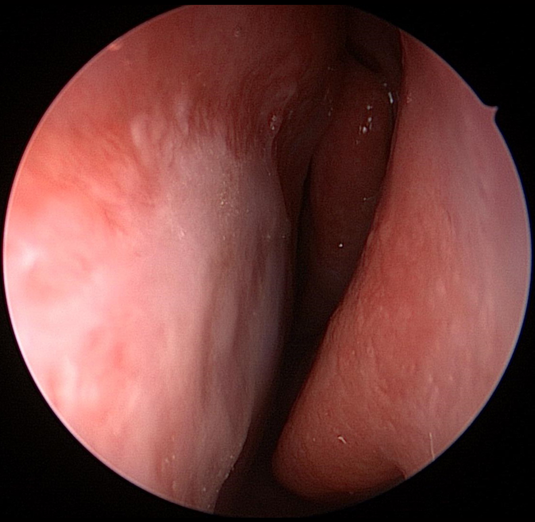 Repaired-Septal-Perforation-1