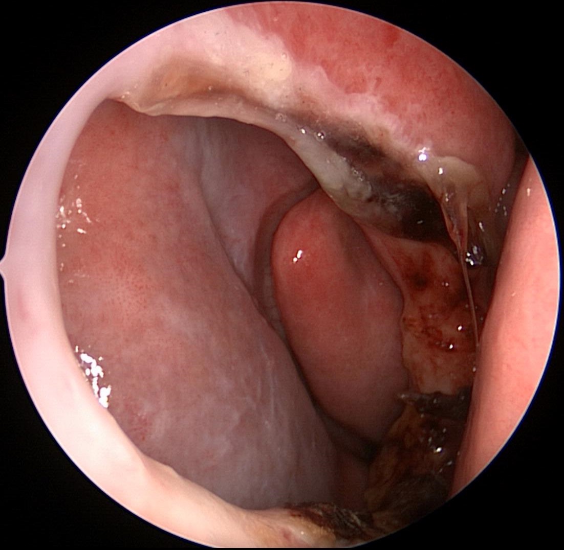 Septal Perforation