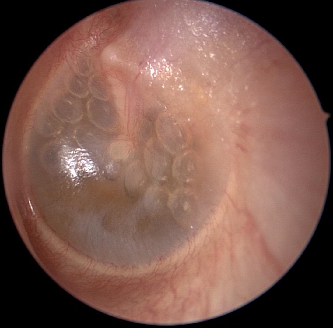 Serous Effusion With Air Bubbles