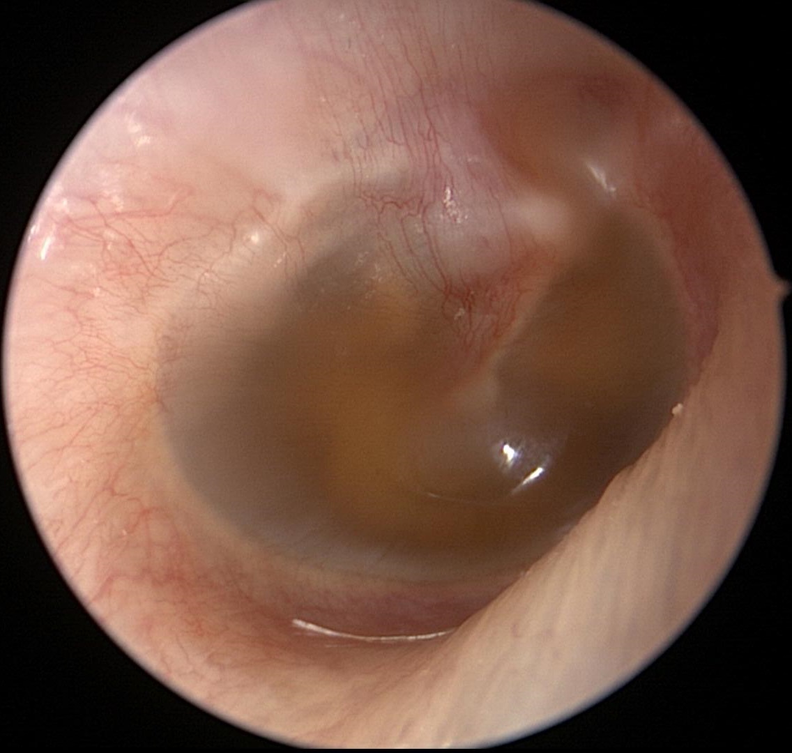 Serous Effusion Without Air Bubbles