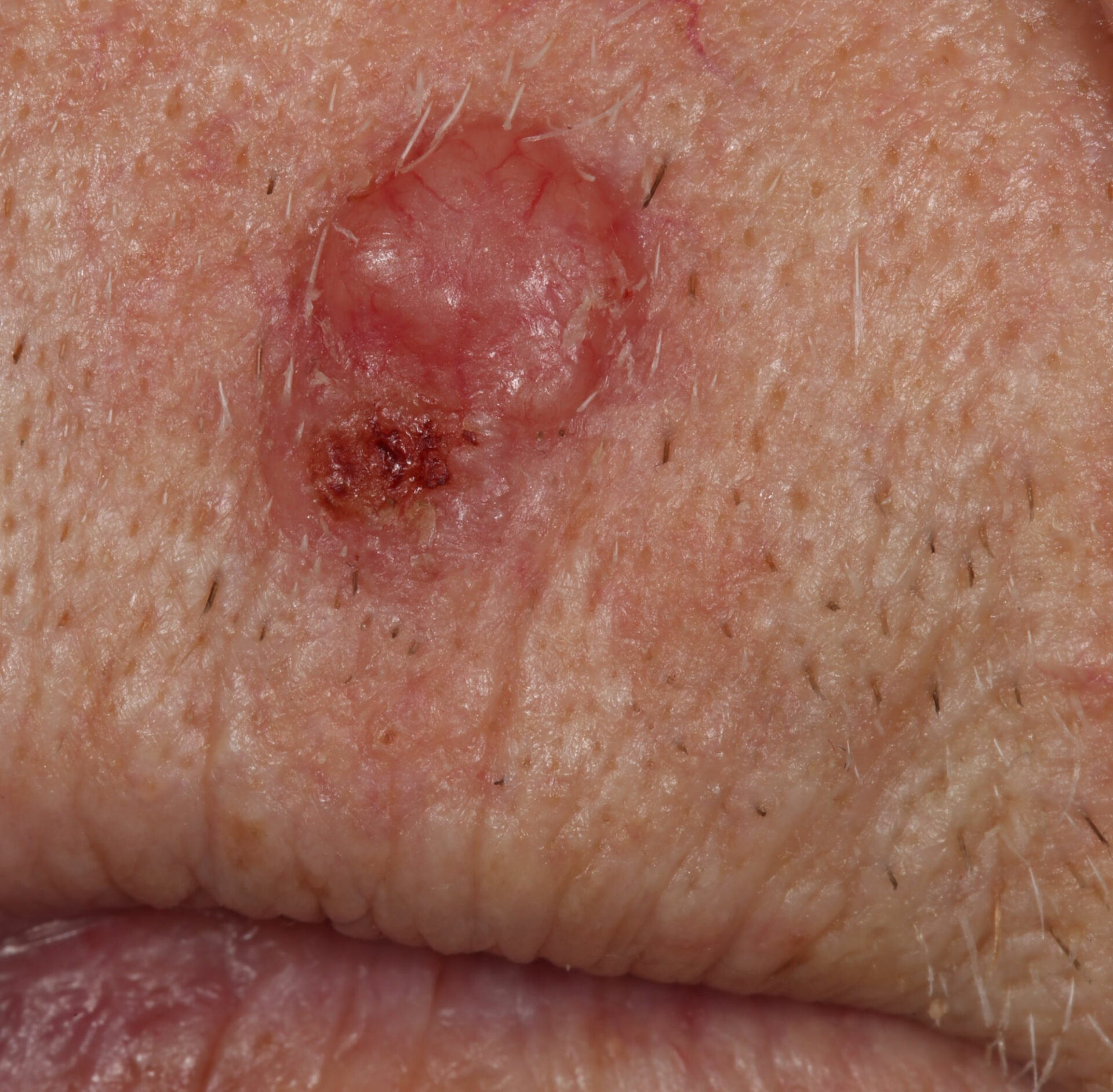 Skin-Lesions-Of-The-Face-1