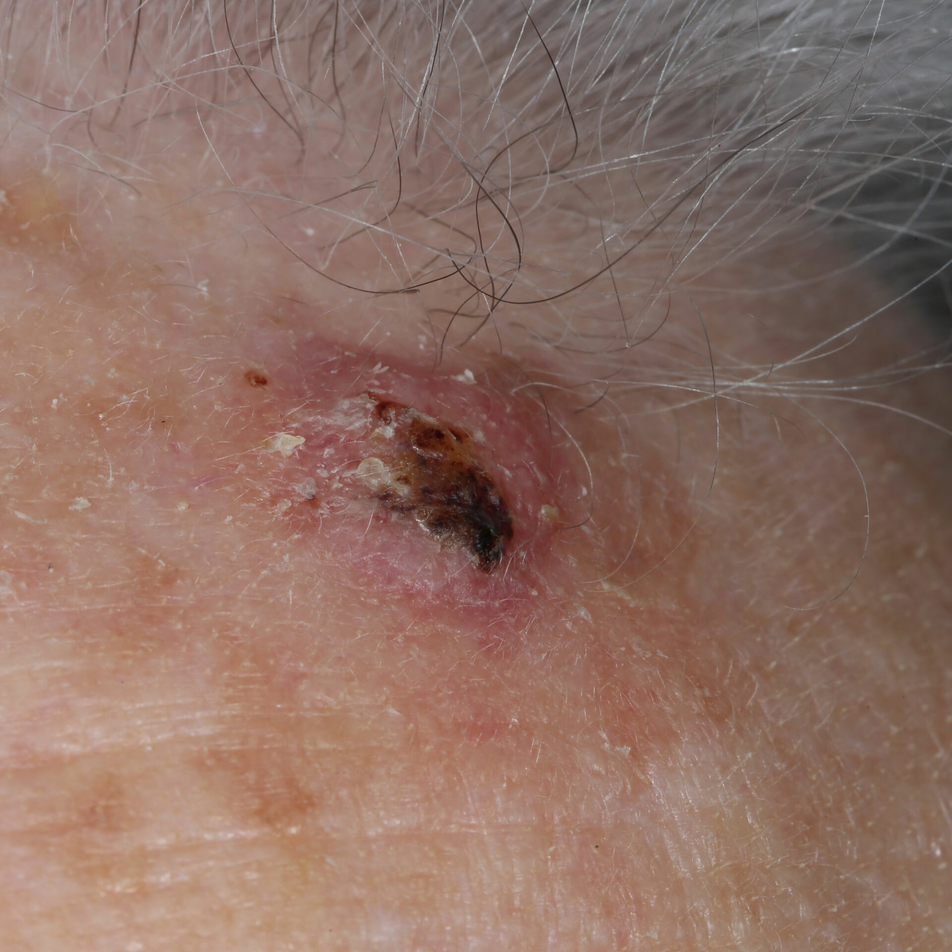 Skin-Lesions-Of-The-Head-1