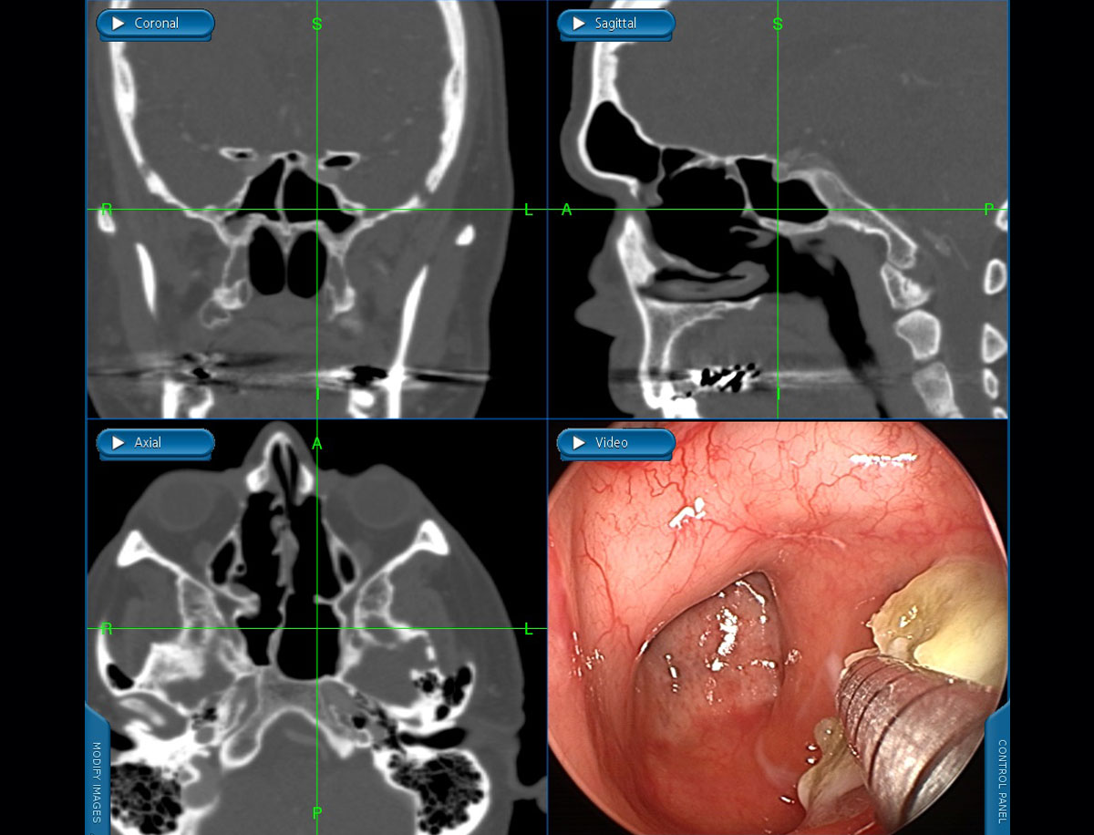 Sphenoid-Sinus-2