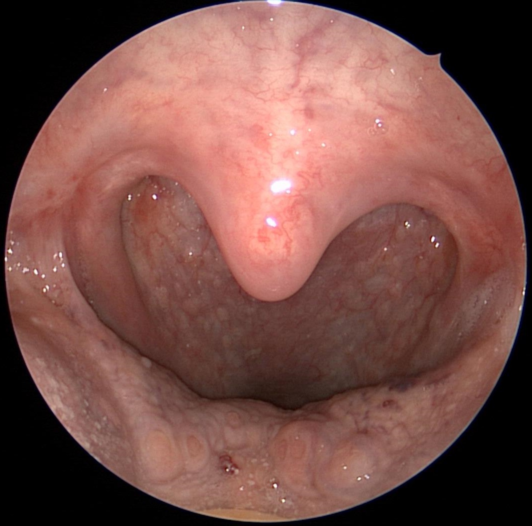 Throat With No Tonsils