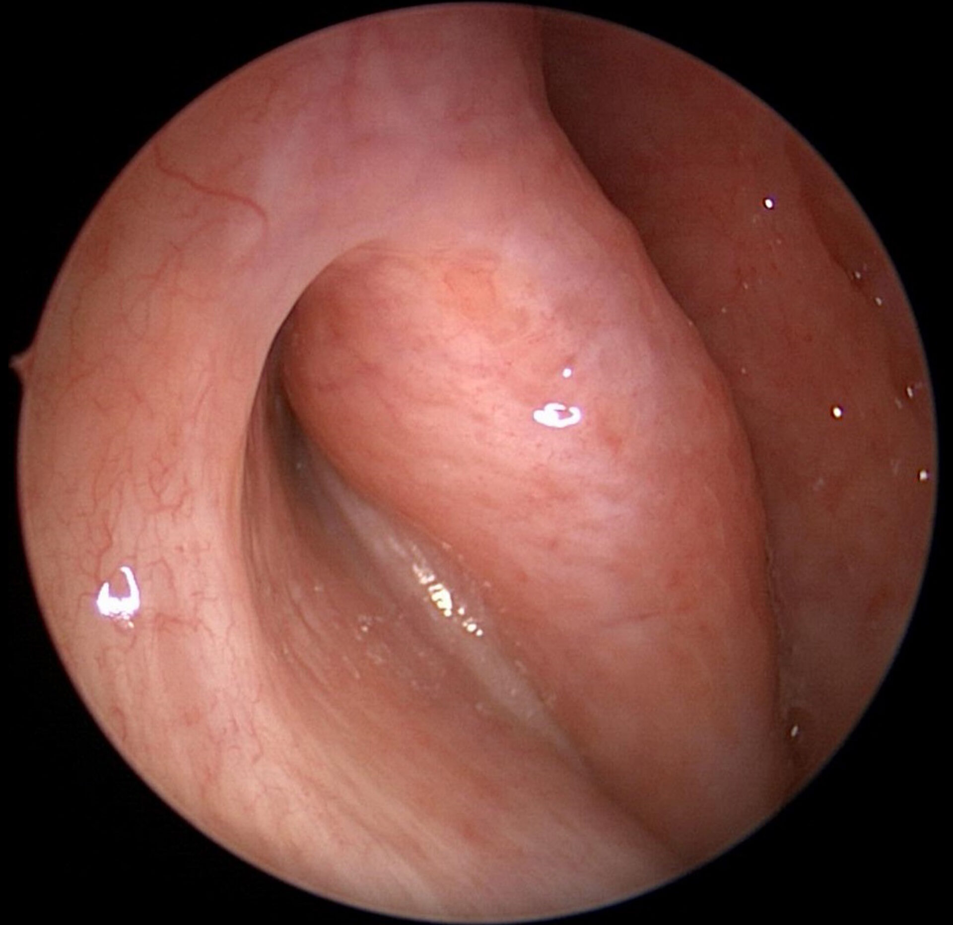 Torus-Tubarius-Of-The-Eustachian-Tube-1