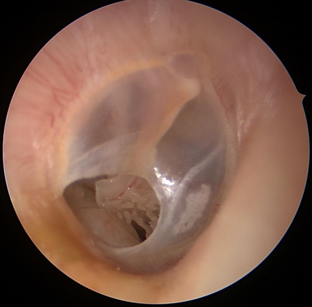 Tympanic Membrane Perforation Column 2