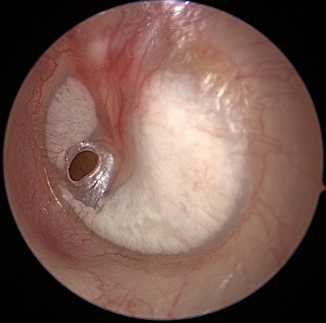 TympanicMembranePerforation (Early)