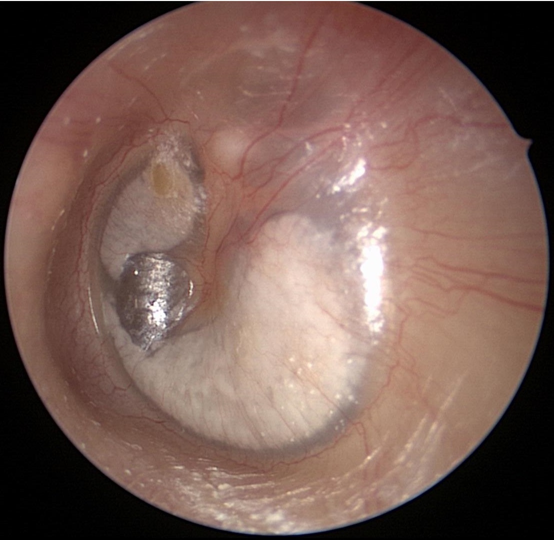 TympanicMembranePerforation (Healed)